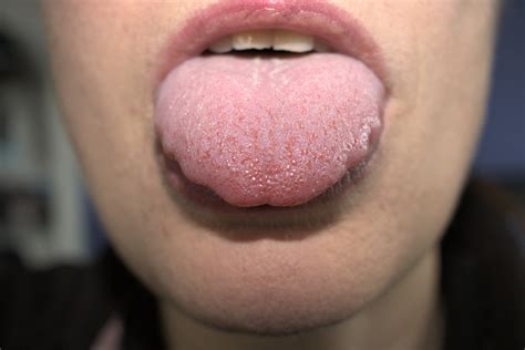 reddit tip of my tongue|swollen tongue on one side.